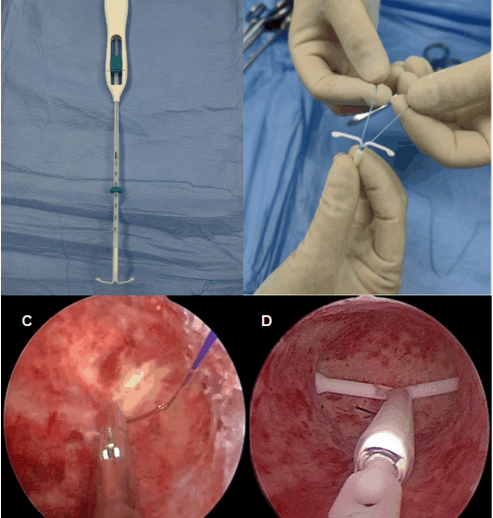 Clinical value of hysteroscopic levonorgestrel intrauterine system suture fixation in treating adenomyosis | BMC Women's Health