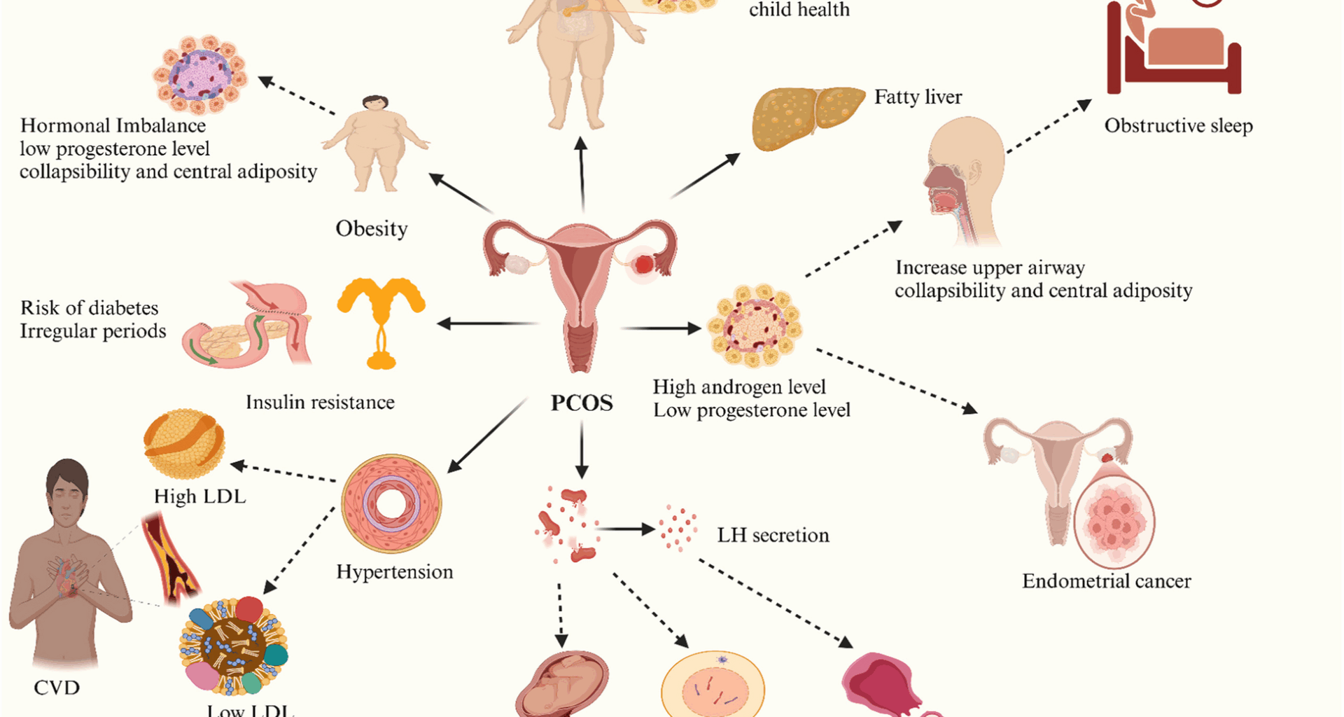 Polycystic ovarian syndrome a risk factor for non-communicable diseases: insights into recent research and prevention approaches | Journal of Ovarian Research