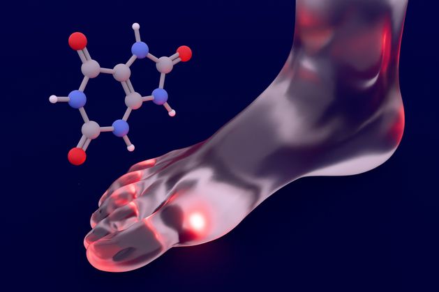 Stay Well: I’ve been diagnosed with gout – what is it and can I get rid of it?