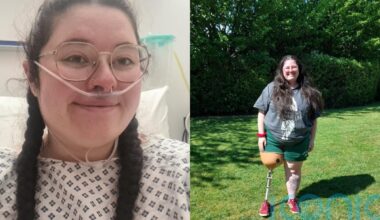NHS nurse who had leg amputated after rare tumour found in calf says going into ‘survival mode’ helped her ‘stay positive’