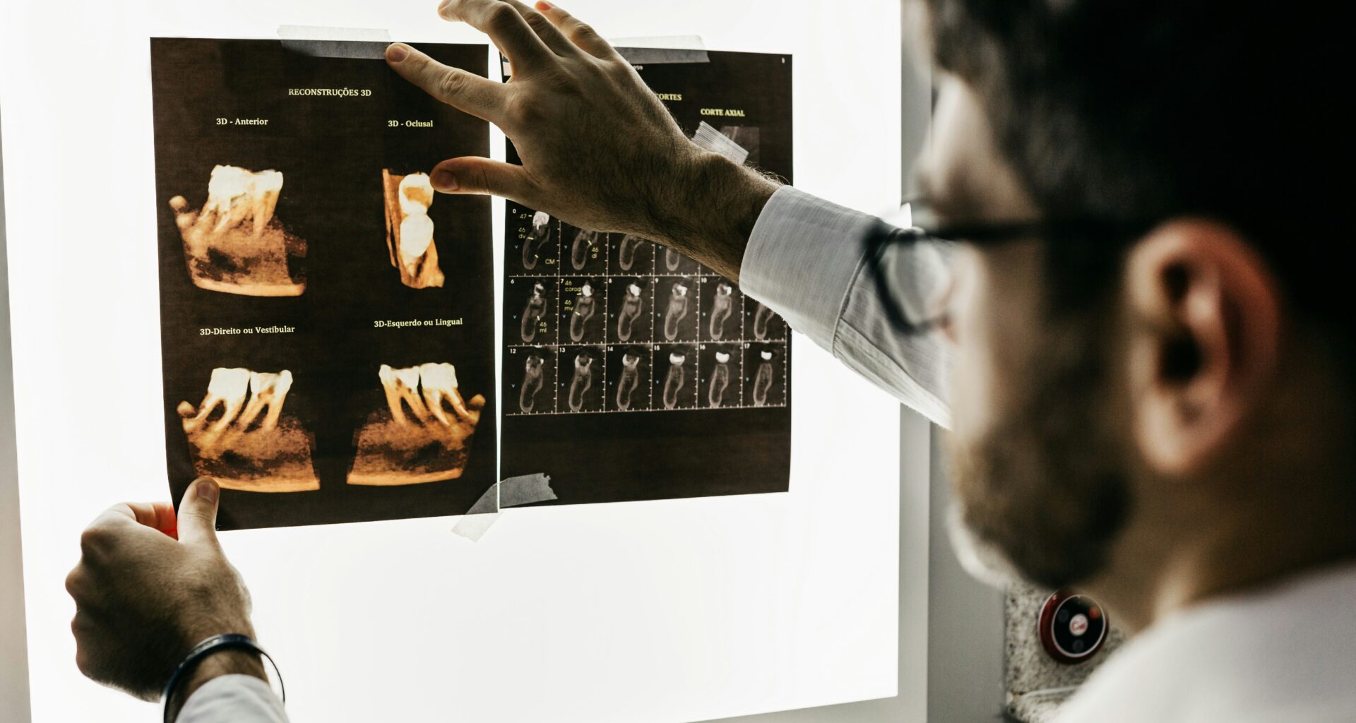 First Large-scale Alzheimer Disease Study In Brain Tissue From African American Donors Implicates Roles For Many Novel Genes