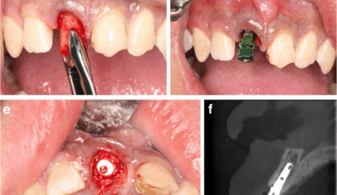 Immediate implant placement for single failed maxillary anterior teeth after trauma: a case-series study | BMC Oral Health