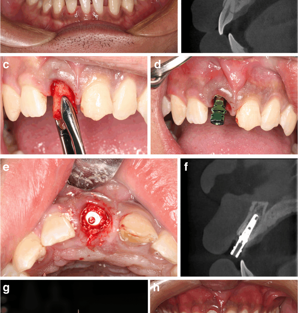 Immediate implant placement for single failed maxillary anterior teeth after trauma: a case-series study | BMC Oral Health