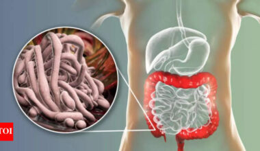Intestinal Parasites Symptoms: Do you have intestinal parasites? Gastroenterologist shares common symptoms to be aware of |