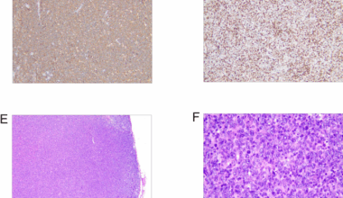 Cold versus warm autoimmune hemolytic anemia in diffuse large B cell lymphoma: pathogenic and therapeutic implications: a case series | Journal of Medical Case Reports