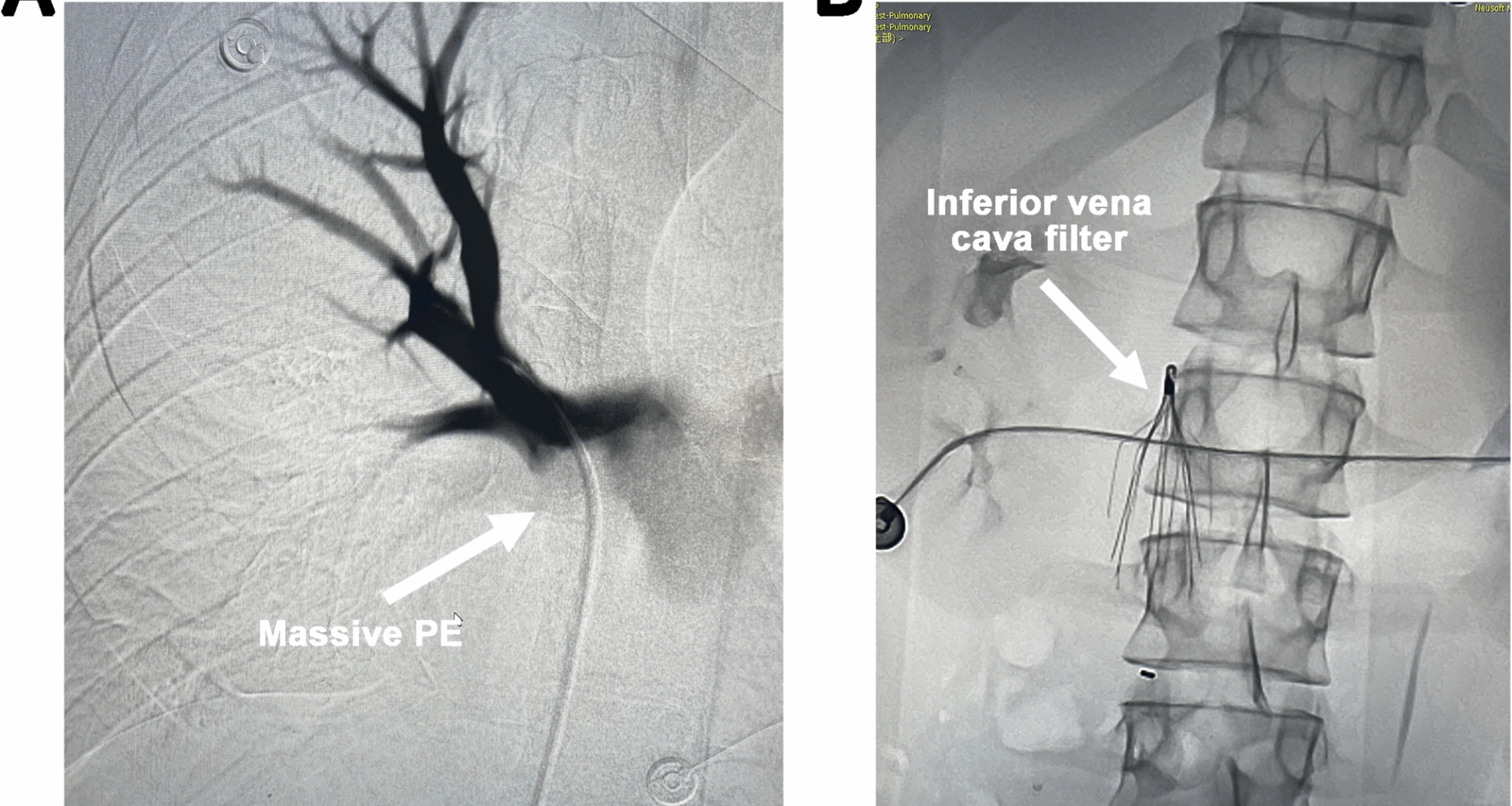 Inserting a venoarterial extracorporeal membrane oxygenation drainage cannula into the inferior vena cava through the internal jugular vein in a patient with an inferior vena cava filter | International Journal of Emergency Medicine