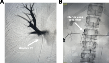 Inserting a venoarterial extracorporeal membrane oxygenation drainage cannula into the inferior vena cava through the internal jugular vein in a patient with an inferior vena cava filter | International Journal of Emergency Medicine