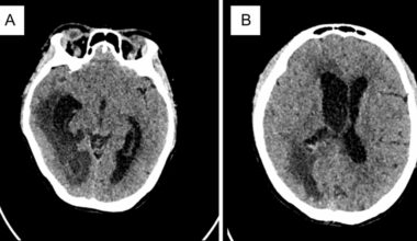 Management of meningitis in critical obstetric patients: a case report | Journal of Medical Case Reports