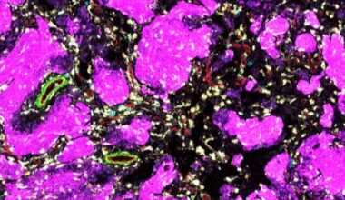 New study ‘changes how scientists think’ about low grade brain tumours in children