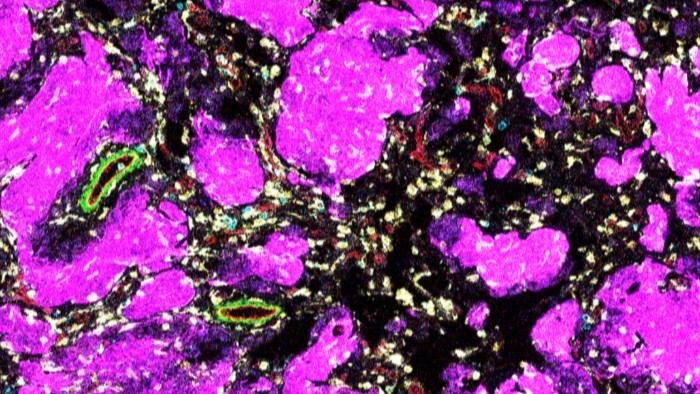 New study ‘changes how scientists think’ about low grade brain tumours in children