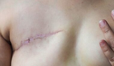 The Relentless Quest for a Breast