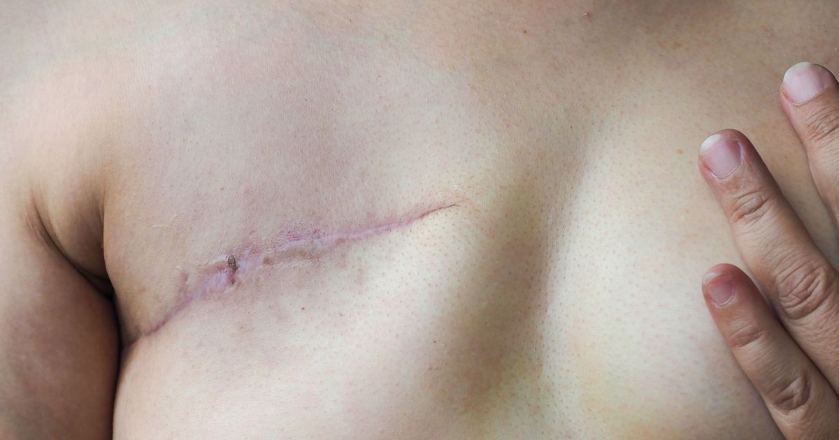 The Relentless Quest for a Breast