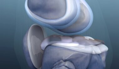 Commercial robotic leg could benefit both higher- and lower-mobility amputees