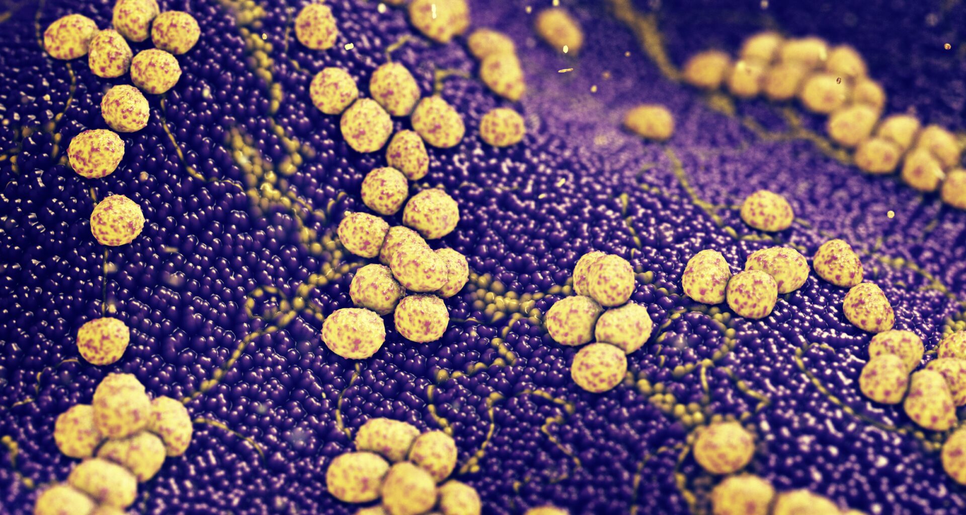 PCR boosts detection of bacteria in pediatric bone and joint infections