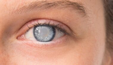 Revolutionizing cataract surgery with office-based oral sedation