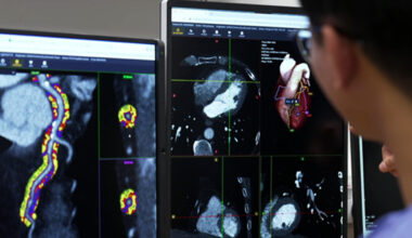 AI heart scan targets risk before plaque