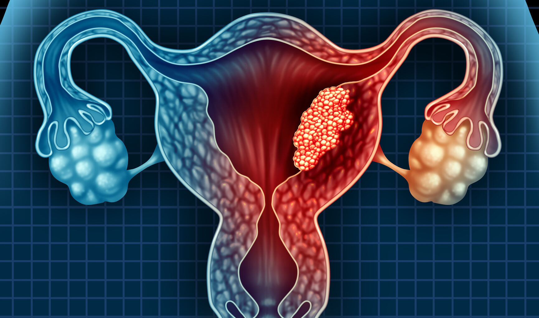 Aggressive Endometrial Cancer Linked to Metabolic Activity in Visceral Fat  