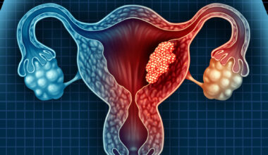 Aggressive Endometrial Cancer Linked to Metabolic Activity in Visceral Fat  