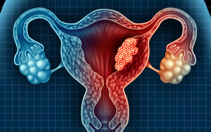 Endometrial cancer