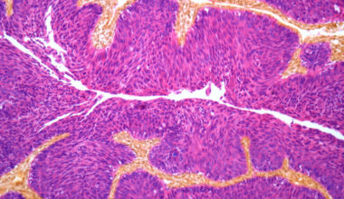 ctDNA blood test could change how cancer is treated