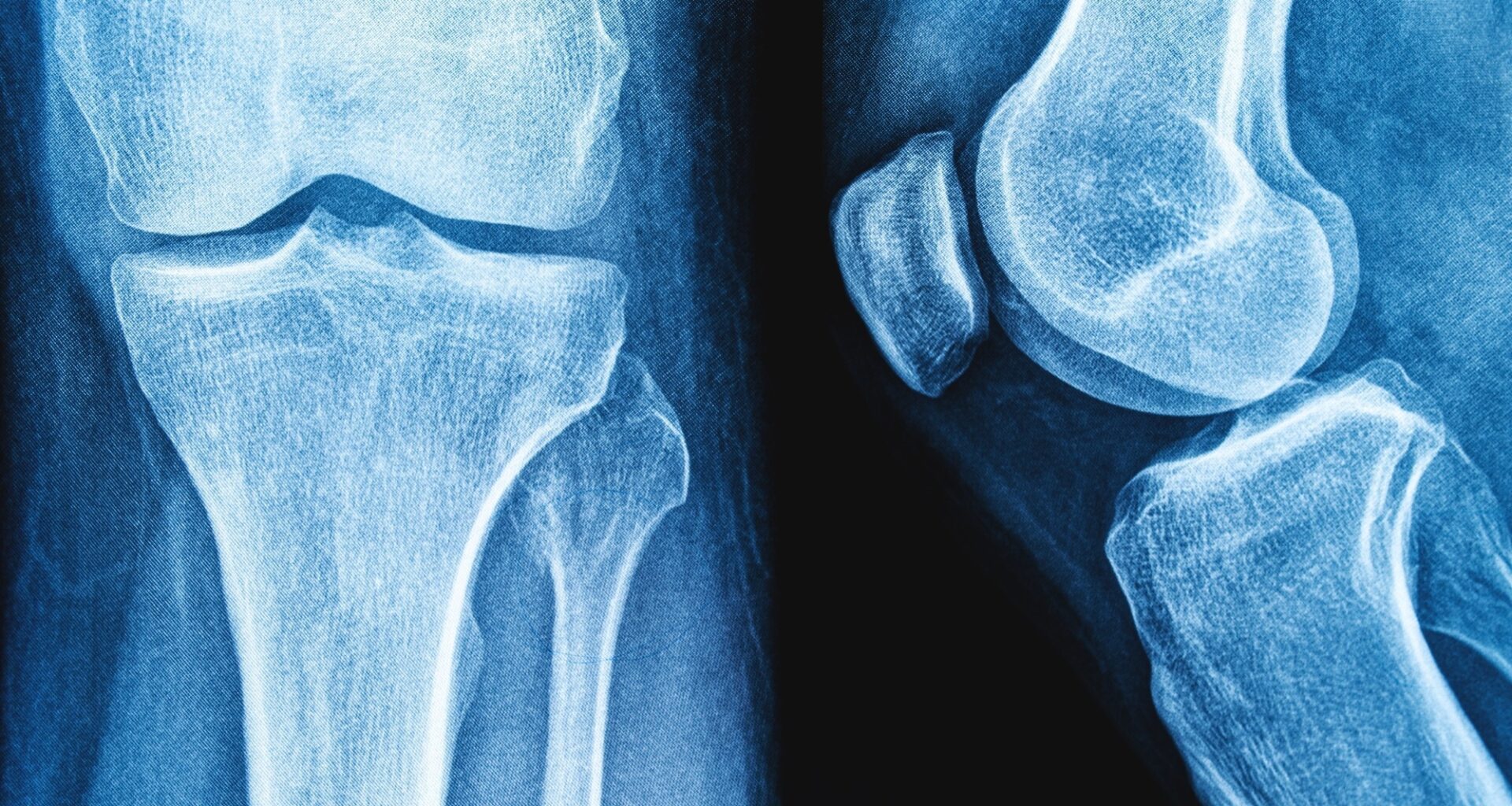 Review: Impact of yogurt consumption on bone health markers in adults with or without osteoporosis: a systematic review and meta-analysis. Image Credit: siamionau pavel / Shutterstock