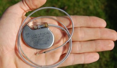 Deep brain stimulation shows promise in reducing severe stuttering