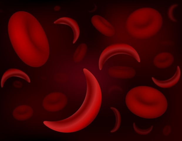 Using placental growth factor to predict preeclampsia risk in pregnant women with sickle cell disease