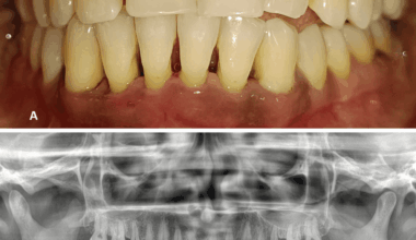 Effect of Non-surgical Periodontal Therapy on Levels of Ghrelin and Tumor Necrosis Factor-Alpha (TNF-α) in the Gingival Crevicular Fluid of Healthy and Periodontitis Patients With and Without Type 2 Diabetes Mellitus: A Clinico-Biochemical Study