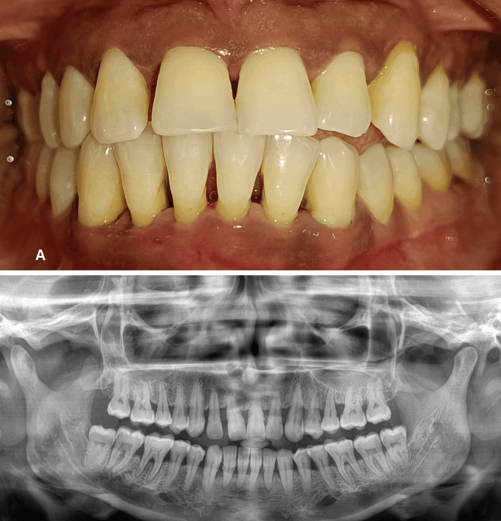 Effect of Non-surgical Periodontal Therapy on Levels of Ghrelin and Tumor Necrosis Factor-Alpha (TNF-α) in the Gingival Crevicular Fluid of Healthy and Periodontitis Patients With and Without Type 2 Diabetes Mellitus: A Clinico-Biochemical Study