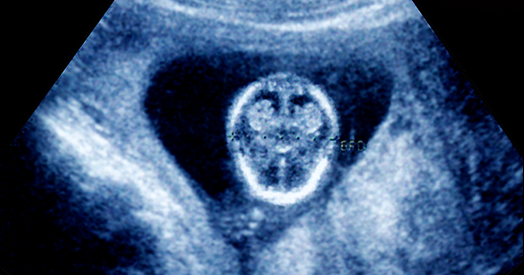 Gene-activity map of developing brain reveals new clues about autism’s sex bias