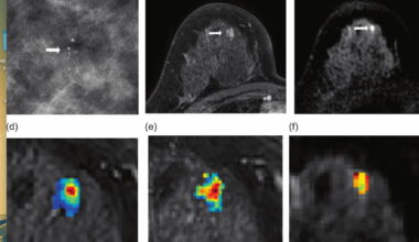 Assessing the Utility of mpMRI for Enhancing Diagnostic Clarity with Suspicious Calcifications from Mammography Exams