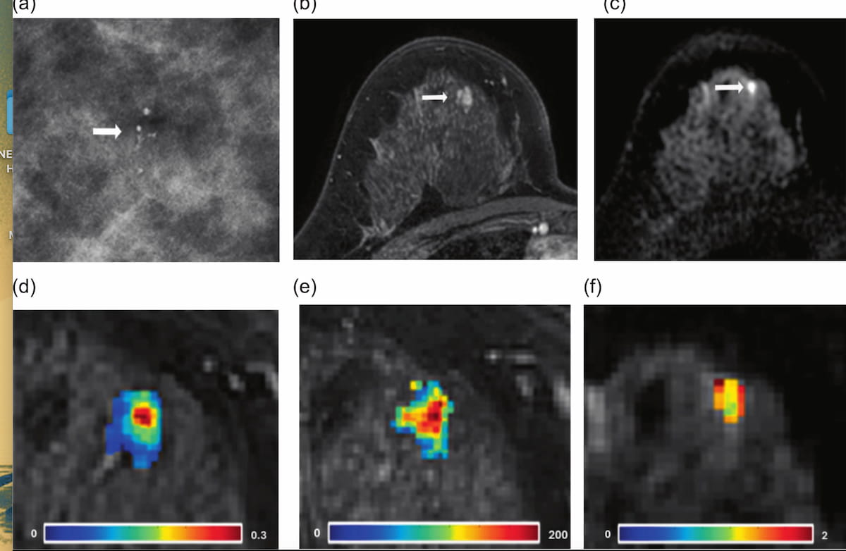 Assessing the Utility of mpMRI for Enhancing Diagnostic Clarity with Suspicious Calcifications from Mammography Exams