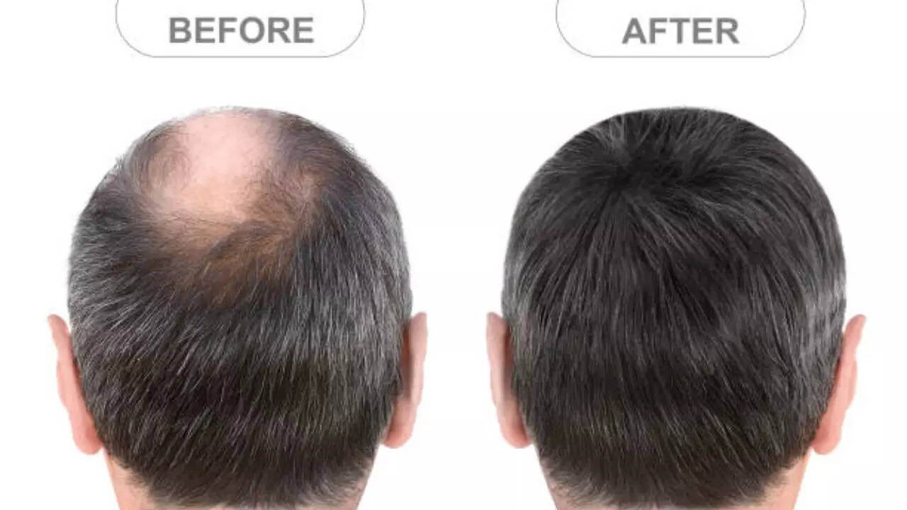 Why This New Oral Minoxidil Could Be the Hair Growth Miracle You've Been Waiting For