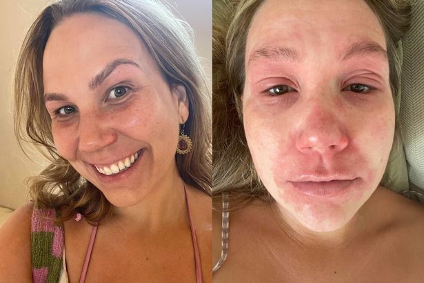 A split image with a picture on the left showing Lily smiling with clear skin, and a picture on the right showing Lily with inflamed skin with red patches