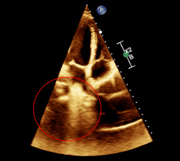 The scan after the ingestion of Lucozade showed swirling bubbles consistent with a gas-filled sliding hiatus hernia (Irish Journal of Medical Science)