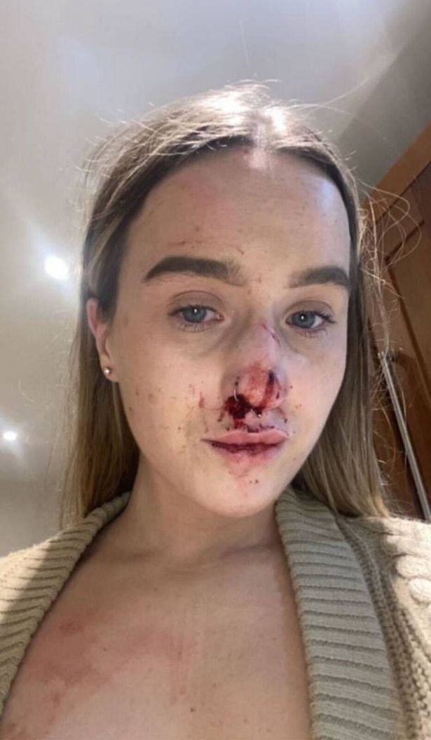 Lauren Boyle Hanney's injuries after the shocking attack by Ronaldo Lupo.