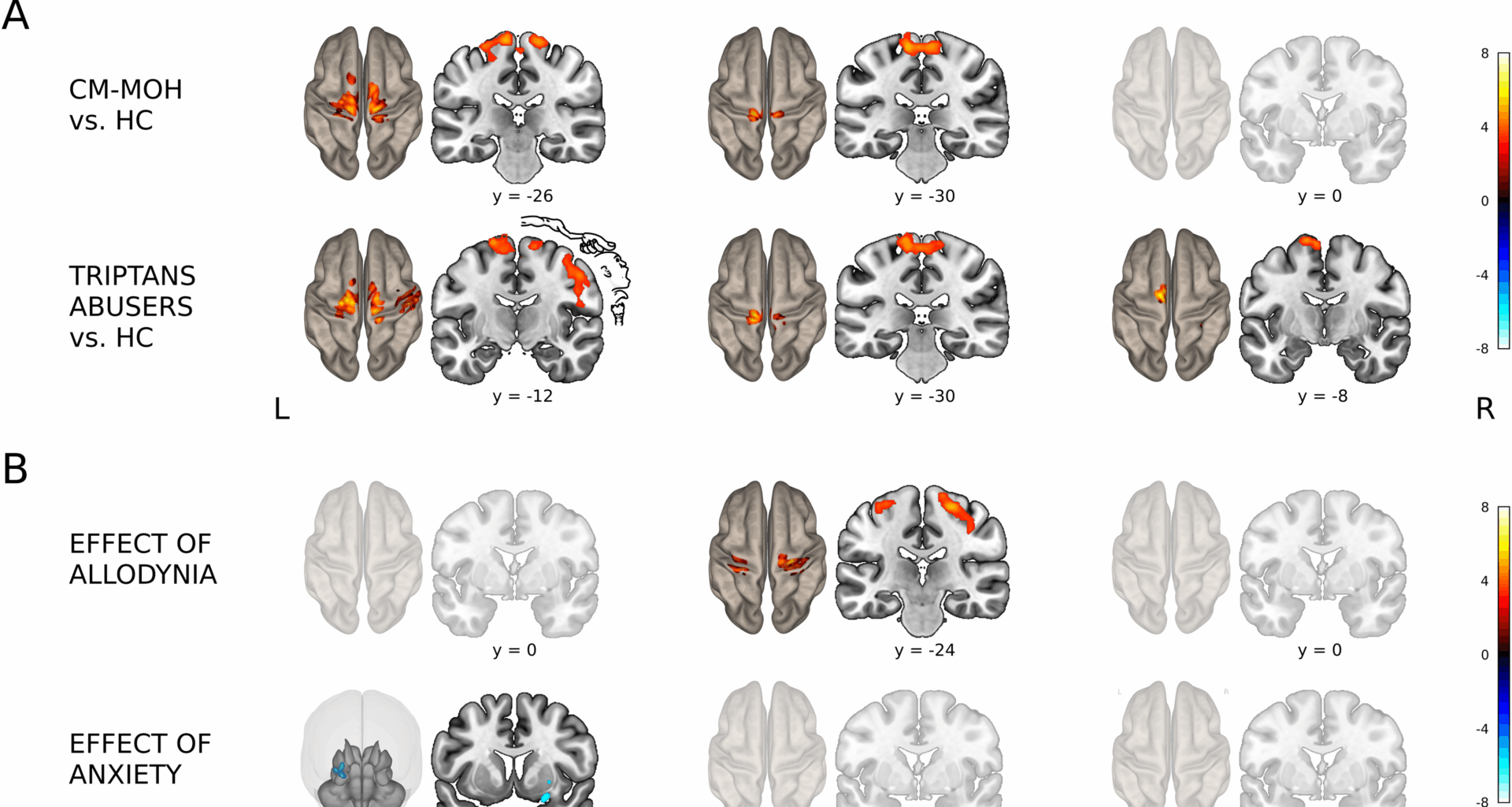 Triple network disruption in medication overuse headache: functional signatures and clinical impact | The Journal of Headache and Pain