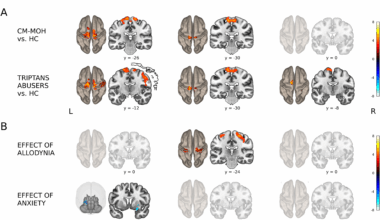 Triple network disruption in medication overuse headache: functional signatures and clinical impact | The Journal of Headache and Pain