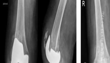 The effect of pulsatile lavage on antibiotic elution from bone cements in two-stage revision for periprosthetic joint infection | Journal of Orthopaedic Surgery and Research