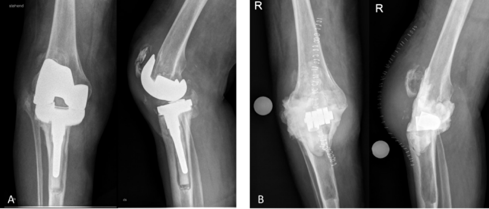The effect of pulsatile lavage on antibiotic elution from bone cements in two-stage revision for periprosthetic joint infection | Journal of Orthopaedic Surgery and Research
