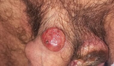 Anaplastic large cell lymphoma in the penis: a case report and review of literature | Journal of Medical Case Reports