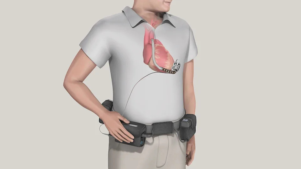 An illustration of a man in a white T-shirt wearing a black belt holding four small black devices with wires protruding; higher up, we see a scan of his heart, from which a small pump with a tube emerges. A wire links the device and one of the black devices on his belt.