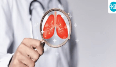 Bengaluru oncologist warns lung cancer is rising among non-smokers; ‘may appear as dry cough, fatigue, or weight loss’