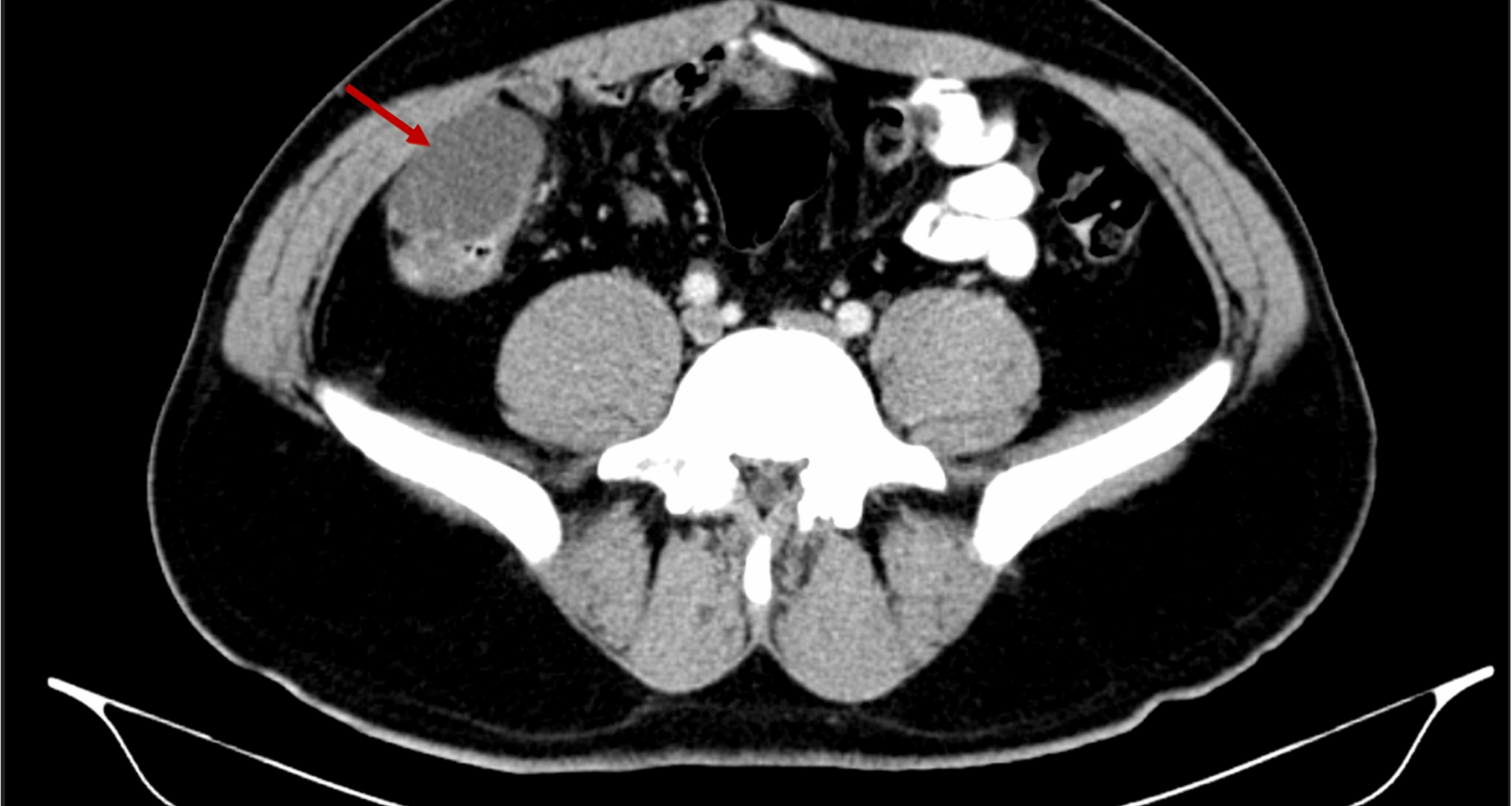 Laparoscopic resection of cecal duplication cyst in a 28 years old male: a rare case report | BMC Surgery
