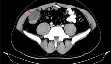 Laparoscopic resection of cecal duplication cyst in a 28 years old male: a rare case report | BMC Surgery