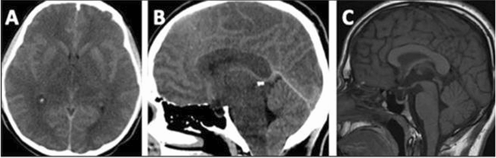 Cerebral edema in maple syrup urine disease: spectrum of clinical presentation and treatment outcomes | Orphanet Journal of Rare Diseases