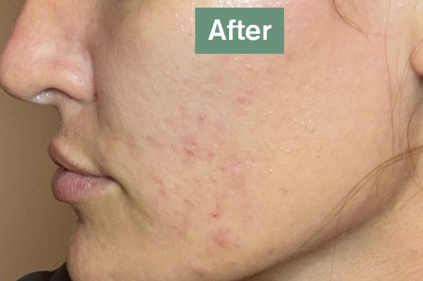 Before and after using Skin Saviour