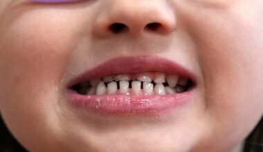FDA restricts use of kids' fluoride supplements citing emerging health risks