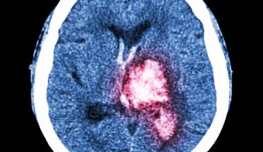 Experimental drug engasertib shows promise for treating inherited bleeding disorder