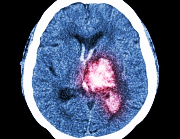 Experimental drug engasertib shows promise for treating inherited bleeding disorder